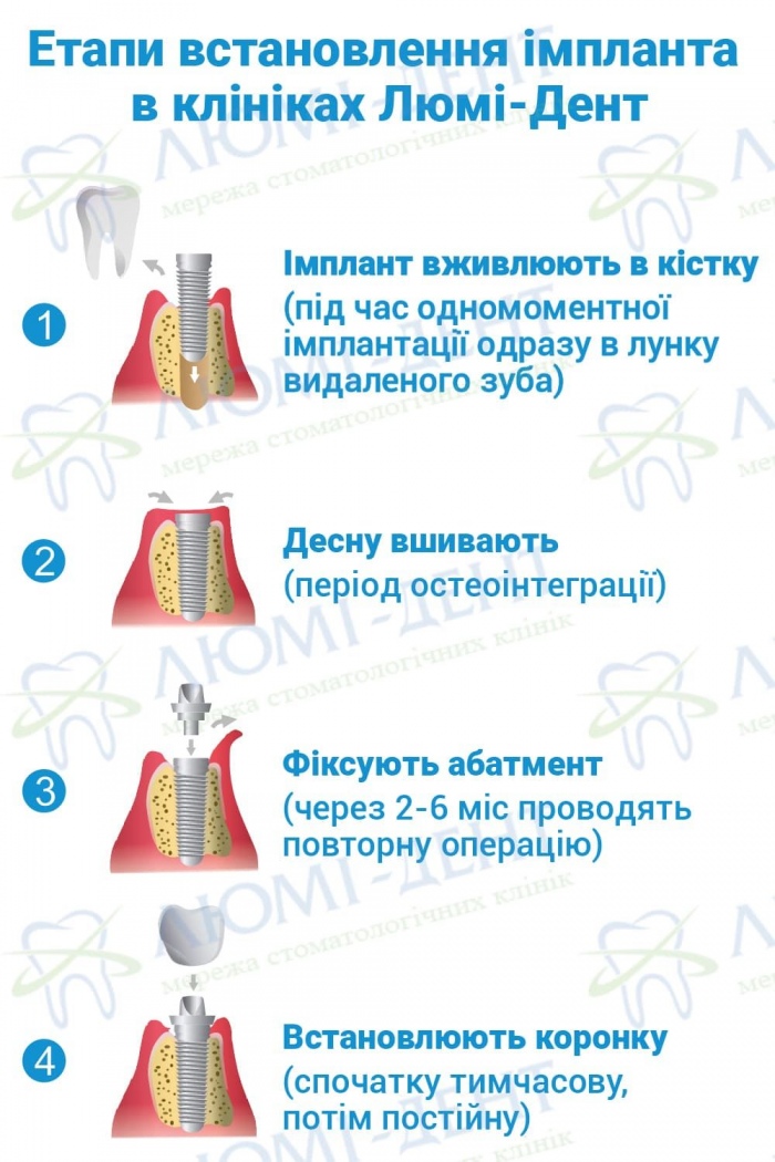 Етапи встановлення імпланта Етапи встановлення імпланта