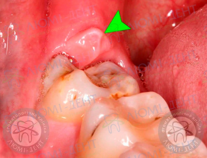Перикоронарит зуба мудрости фото Люми-Дент