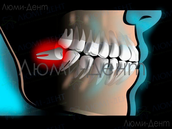 Перикоронит зуба мудрости фото Люми-Дент