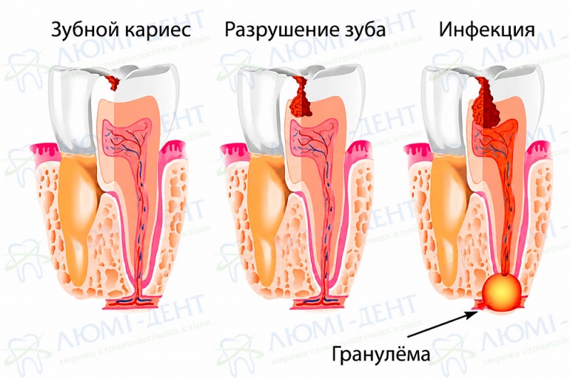 Изображение стадий развития гранулемы зуба Хронический гранулематозный периодонтит фото Люми-Дент