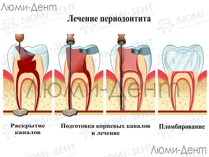 Болит зуб заболел фото Люми-Дент