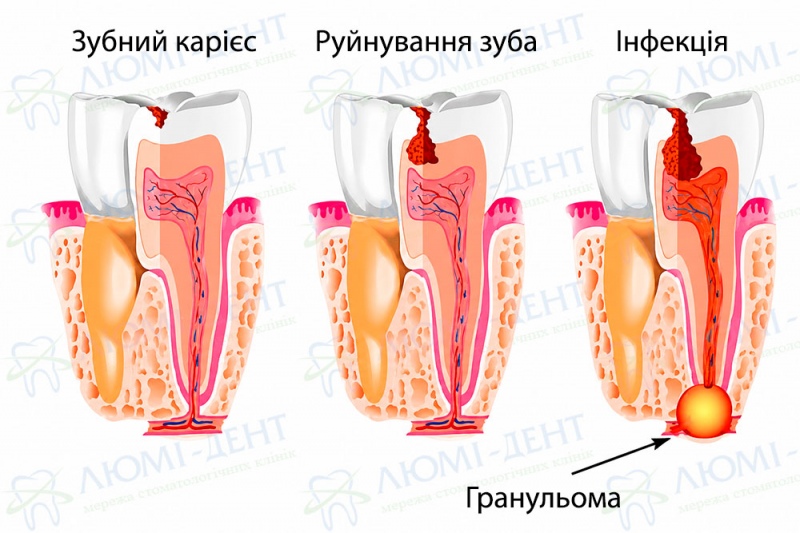 Зображення стадій розвитку гранулеми зуба Періодонтит симптоми фото Люмі-Дент