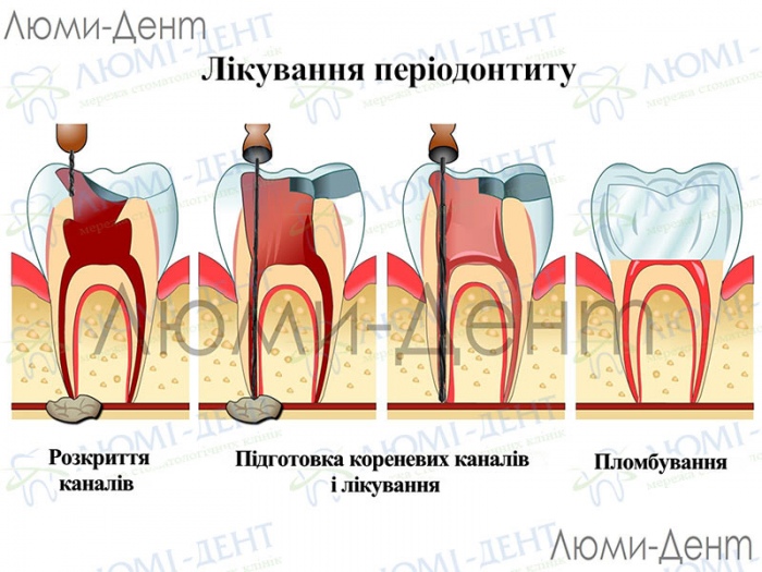 Гранулюючий періодонтит фото Люмі-Дент