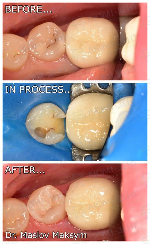 Пломба на зуб зубна пломба фото лікування Люмі-Дент Київ