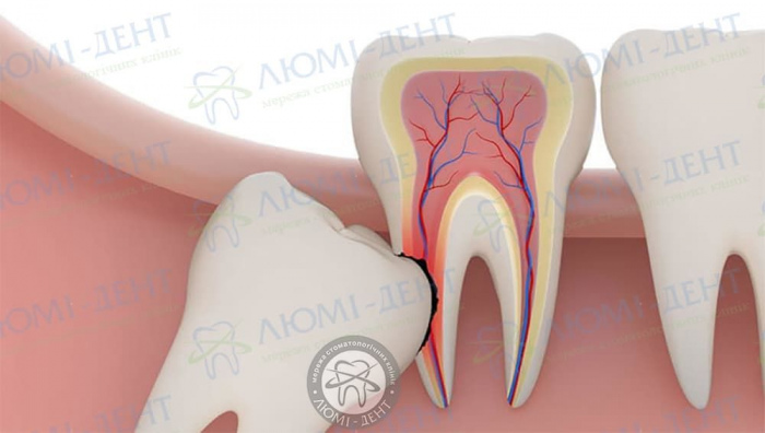 Осложнения после удаления зуба мудрости фото ЛюмиДент