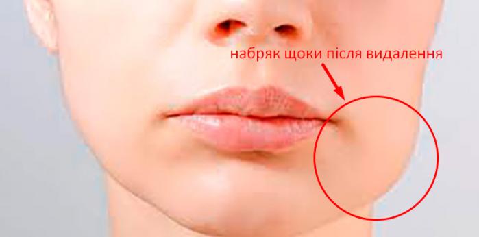 Обличчя після видалення зуба мудрості Лунка після видалення зуба мудрості фото Люмідент
