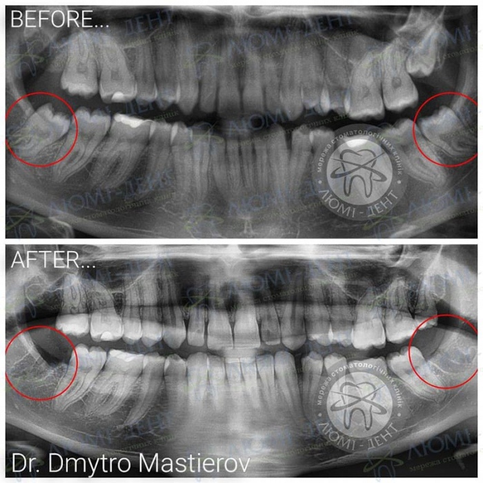 Видалення зуба мудрості наслідки фото ЛюміДент