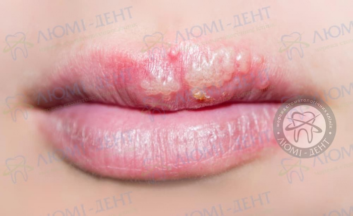 Простуда на губе фото ЛюмиДент
