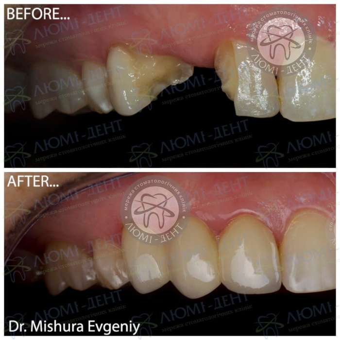 Протезирование мостовидными протезами фото Люми-Дент