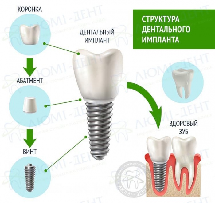 Протезирование зубов имплантами фото Люми-Дент