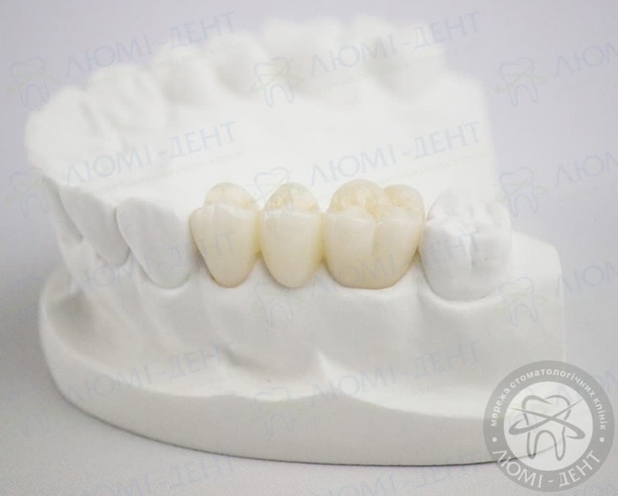 Протезирование зубов коронками фото Люми-Дент