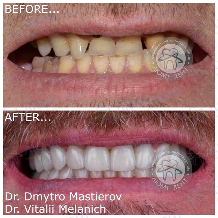 Виды протезирования зубов фото Люми-Дент