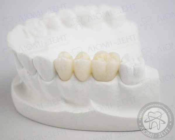 Протезирование зубов коронками фото Люмидент