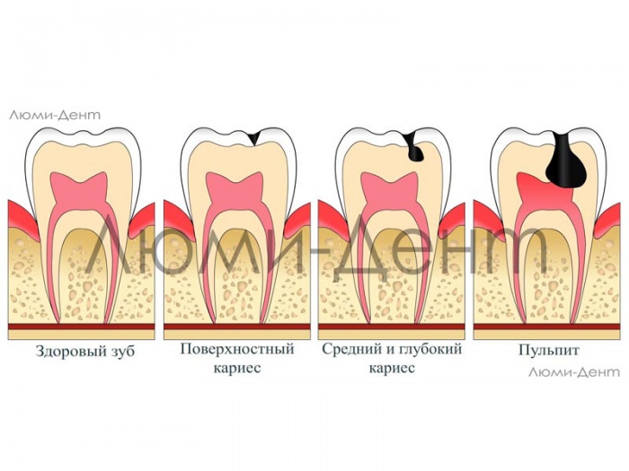 Пульпит лечение симптомы причины фото Люми-Дент