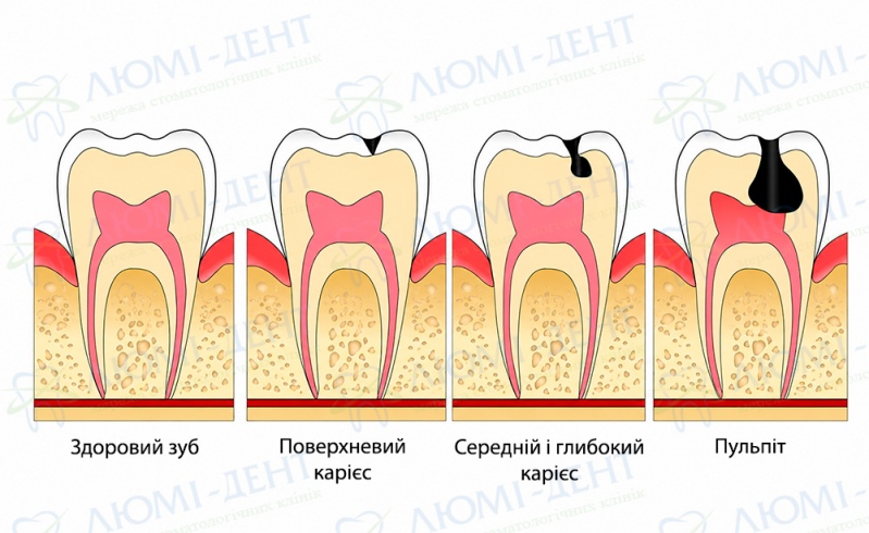 Пульпіт це фото Люмі-Дент