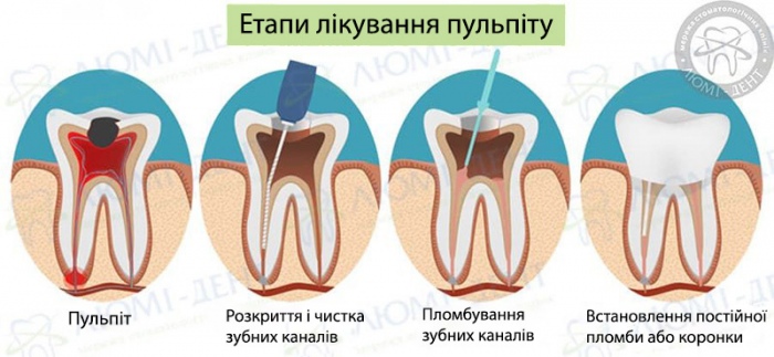 Гострий пульпіт фото Люмі-Дент
