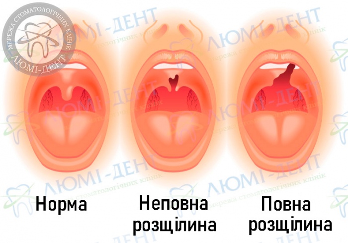 Розщілина піднебіння фото Люмі-Дент