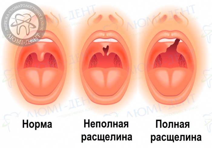 Расщелина неба фото Люми-Дент