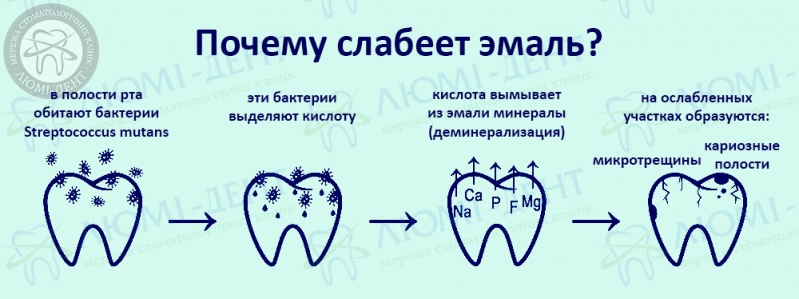 Реминерализация эмали фото Люми-Дент