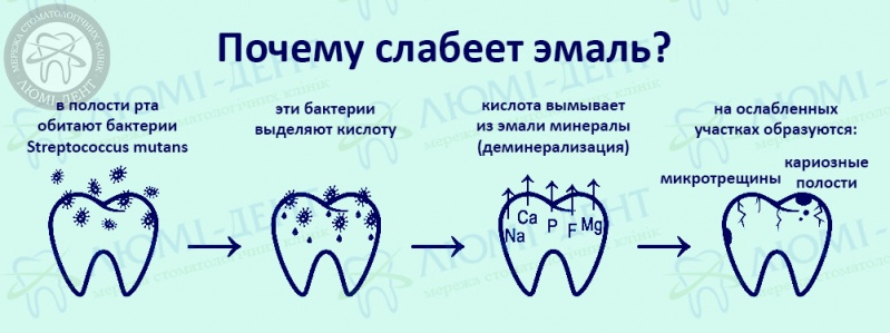 Реминерализация эмали фото Люми-Дент