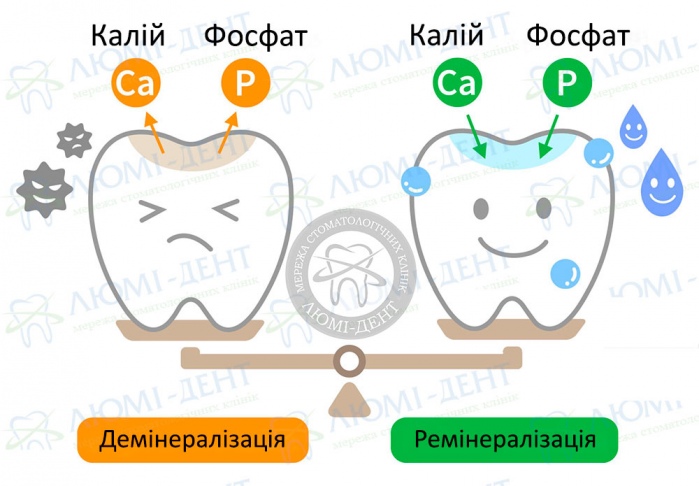 Що таке ремінералізація зубів фото Люмі-Дент
