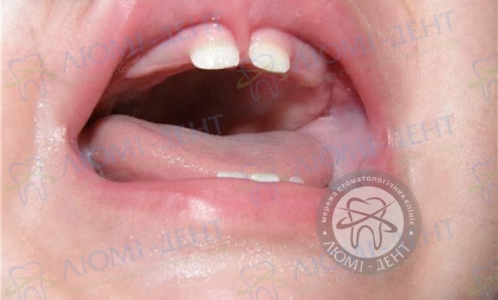 Діастема Щілина між зубами у дорослих фото Люмі-Дент
