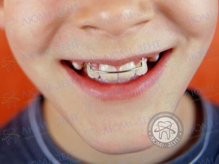 Щілина між передніми зубами фото Люмі-Дент