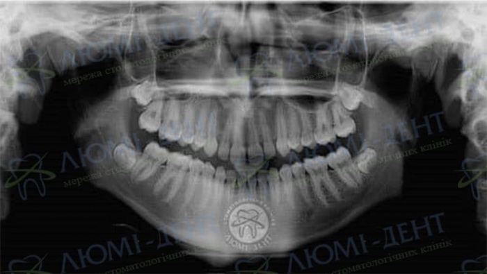 Щілини між зубами фото Люмі-Дент