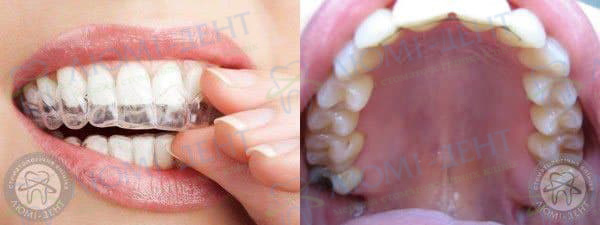 Ретейнер на зуби фото Люмі-дент