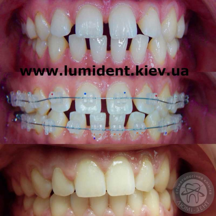 Fixation of a loose tooth in the clinic of Kyiv Lumi-Dent