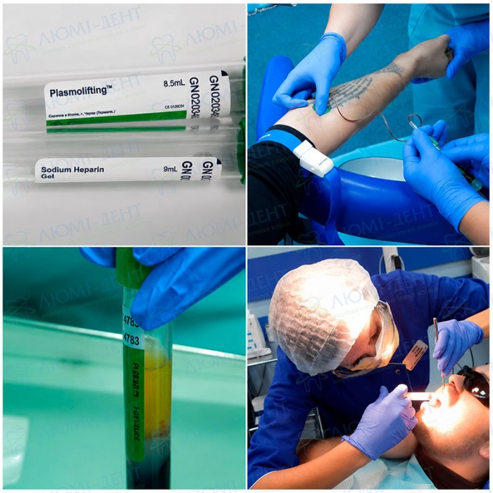 Плазмоліфтинг ясен для зміцнення зубів Хитаються зуби рухливість фото Люмі-Дент