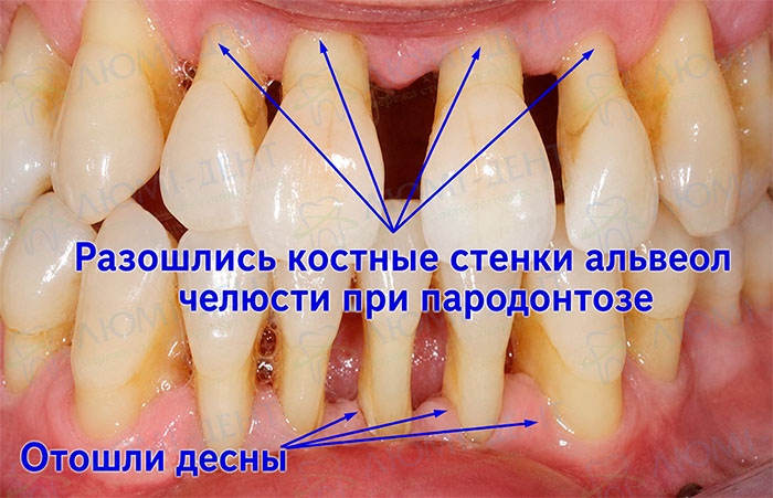 Шатаются зубы при пародонтозе Шатаются зубы подвижность фото Люми-Дент