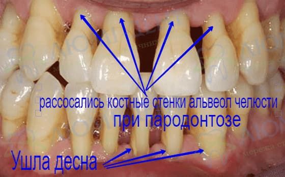 Шатаются зубы подвижность фото Люми-Дент