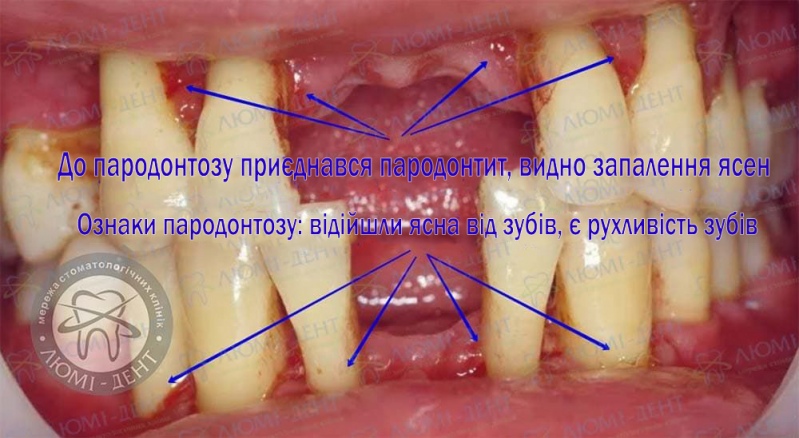 Рухливість зубів фото Люмі-Дент