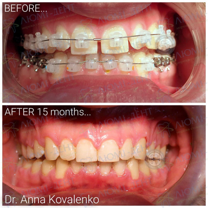 Щілина між зубами після брекетів фото Люмідент
