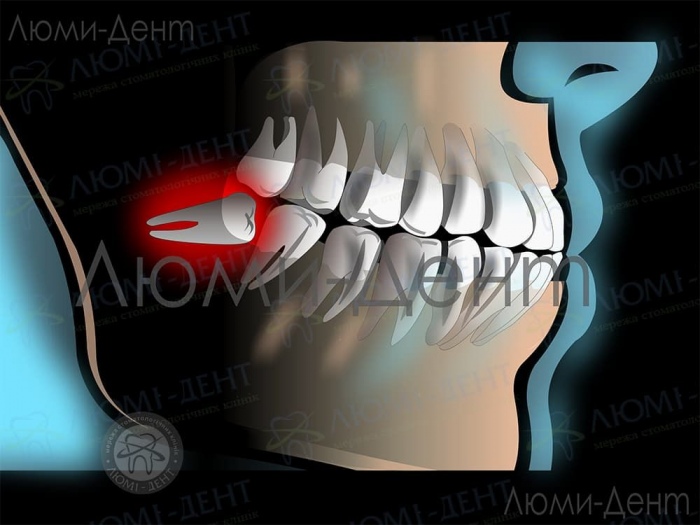 Зуб мудрості симптоми фото ЛюміДент