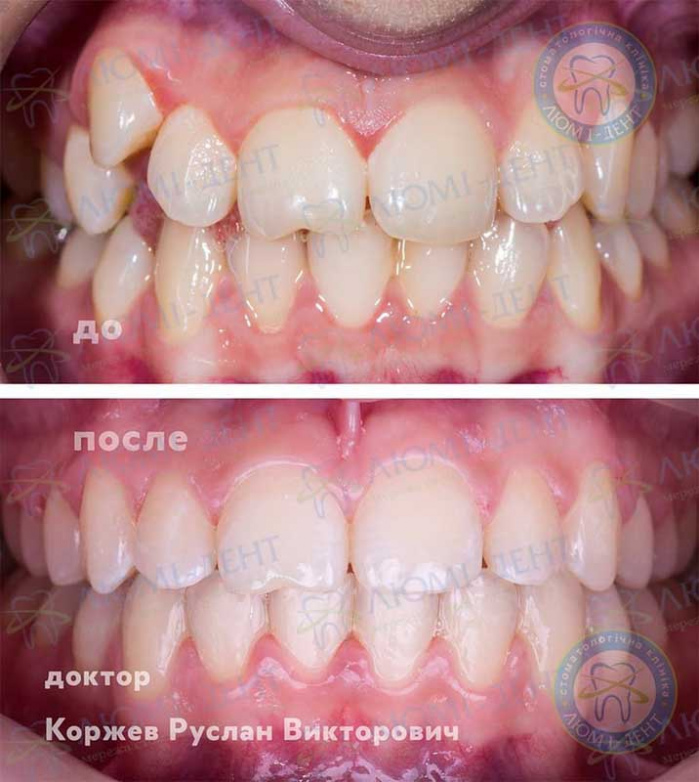 Скученность зубов нижней челюсти фото ЛюмиДент