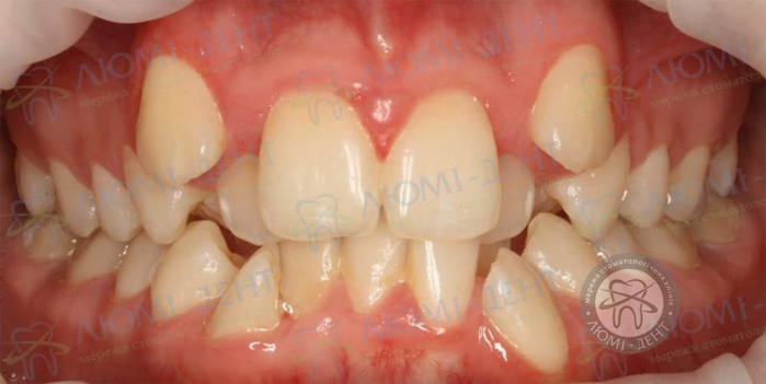 Скупченість зубів це фото ЛюміДент