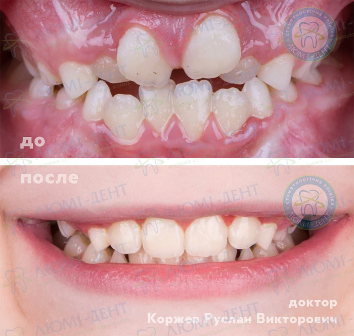 Скупченість зубів лікування фото ЛюміДент