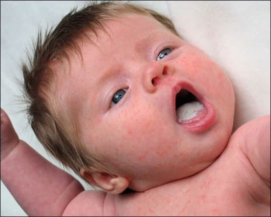 Стоматит у новонародженого фото Люмі-Дент