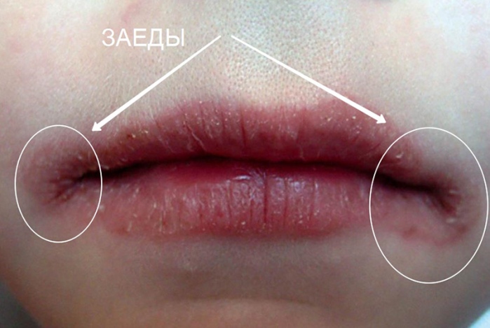 Ангулярный стоматит фото Люми-Дент