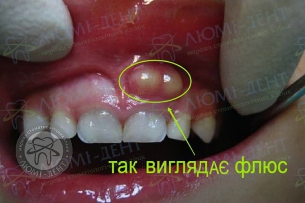 Ефективні засоби для полоскання рота