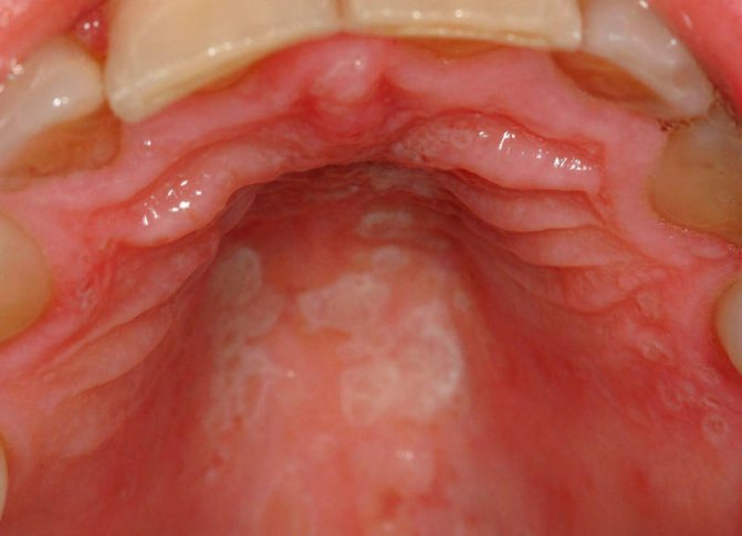 Стоматит Во Рту - 9 Причин - Как Выглядит, Симптомы, Лечение