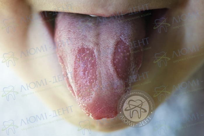 Стоматит у роті фото Люмі-Дент