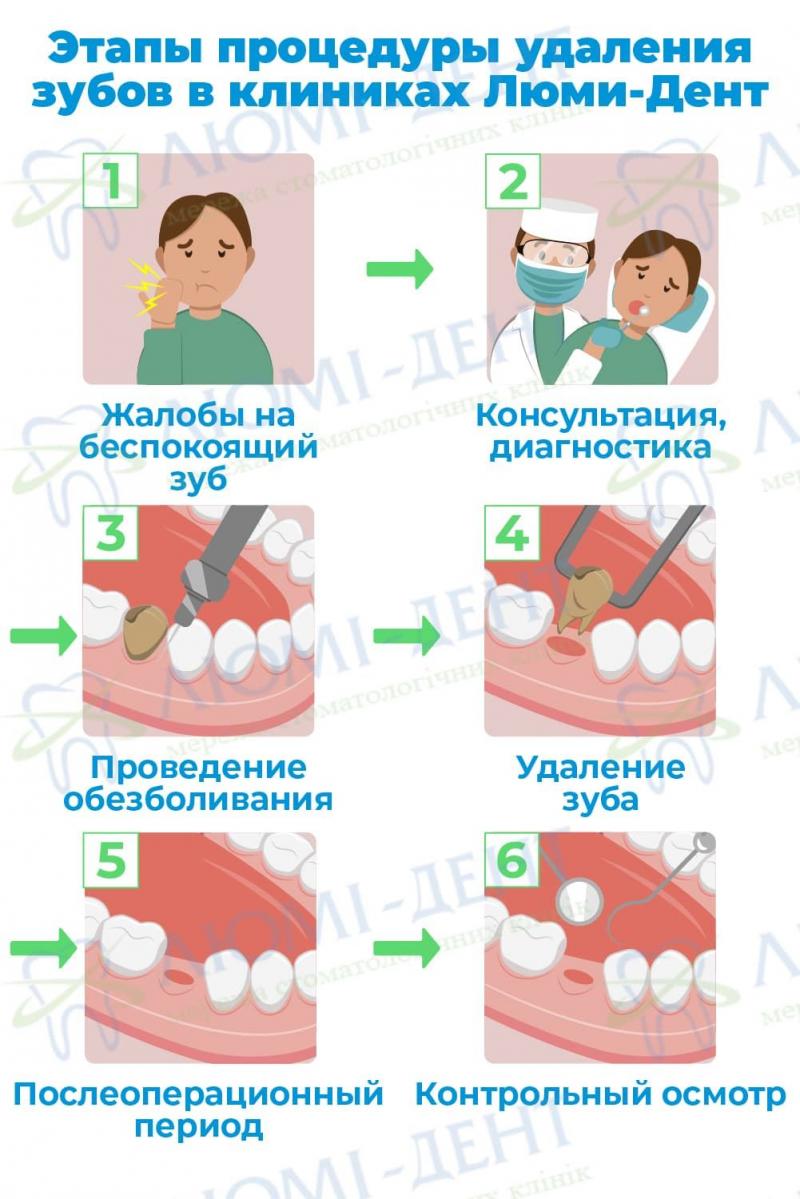 Этапы удаления зубов в клиниках Люми-Дент Удаление зубов фото Люми-Дент