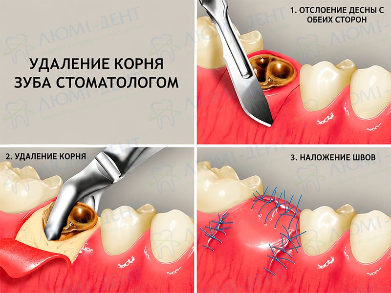 Этапы удаления корней зубов в Люми-Дент Удаление зубов фото Люми-Дент