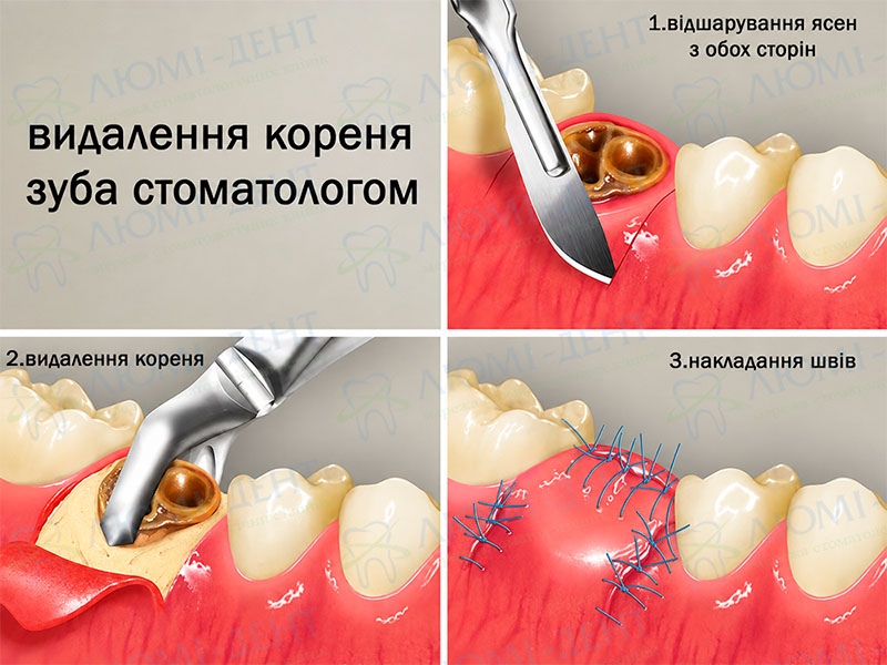 Етапи видалення коренів зубів у Люмі-Дент Чи потрібно видаляти корінь зуба фото Люмі-Дент