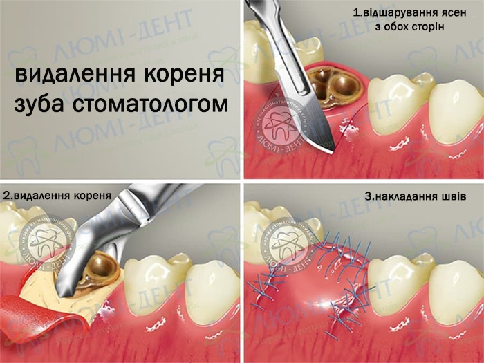 Етапи видалення коренів зубів у Люмі-Дент Чи потрібно видаляти корінь зуба фото Люмі-Дент