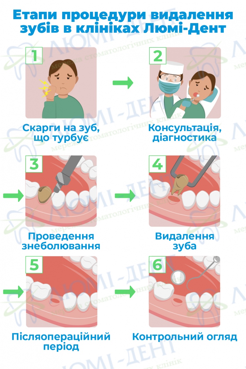 Етапи видалення зубів у клініках Люмі-Дент Етапи видалення зуба фото Люмі-Дент