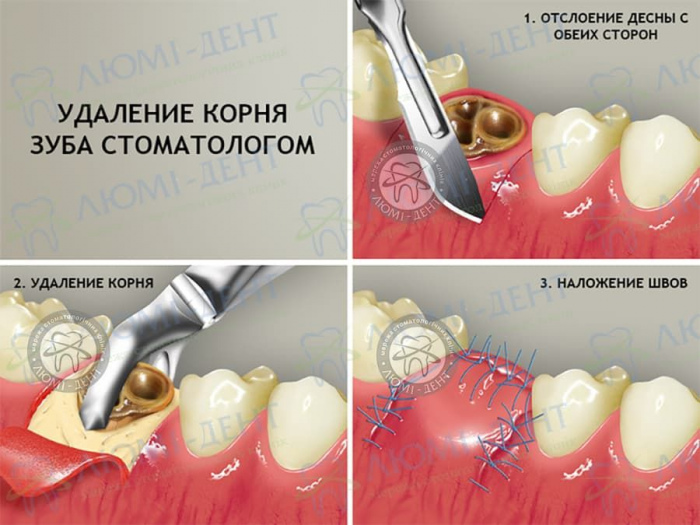 Удаление зубов фото Люми-Дент